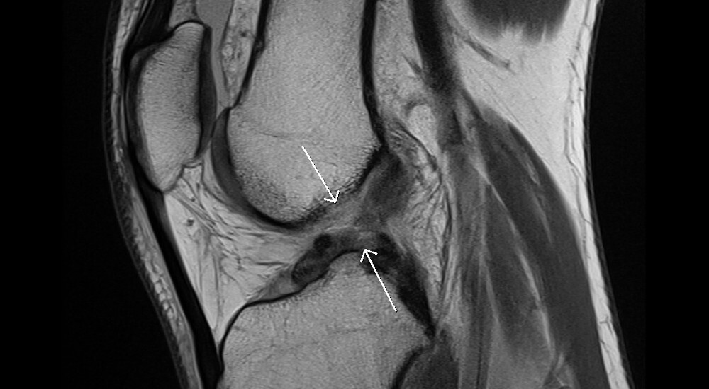 reemplazar ligamentos 1