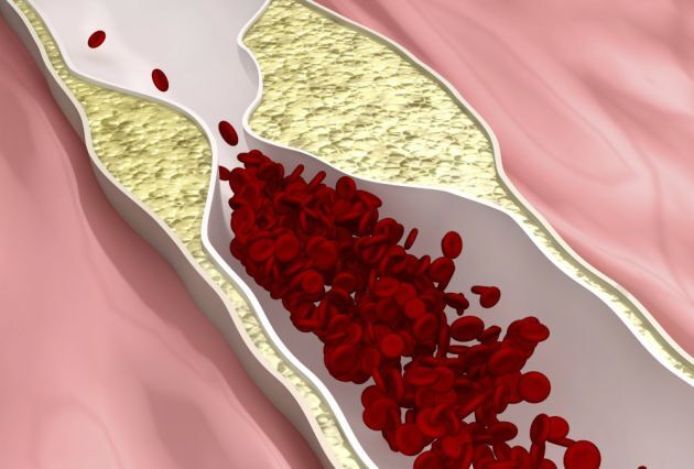 arteriosclerosi