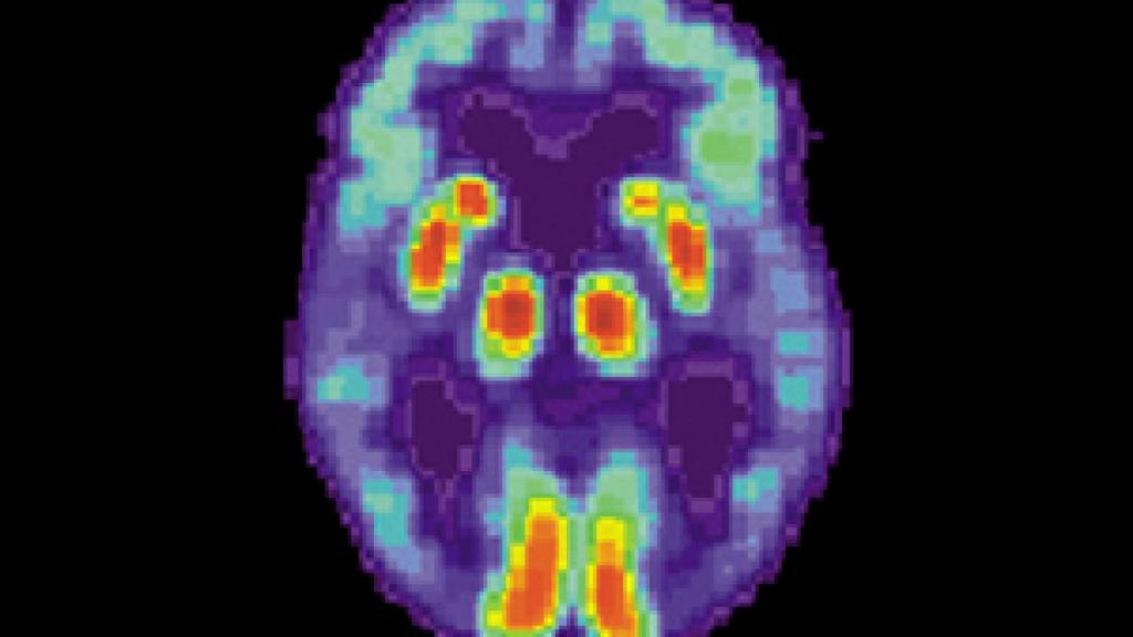 Image: Última hora para prevenir y detectar el Alzheimer