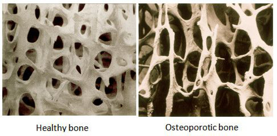 osteoporosisespumainyectable2