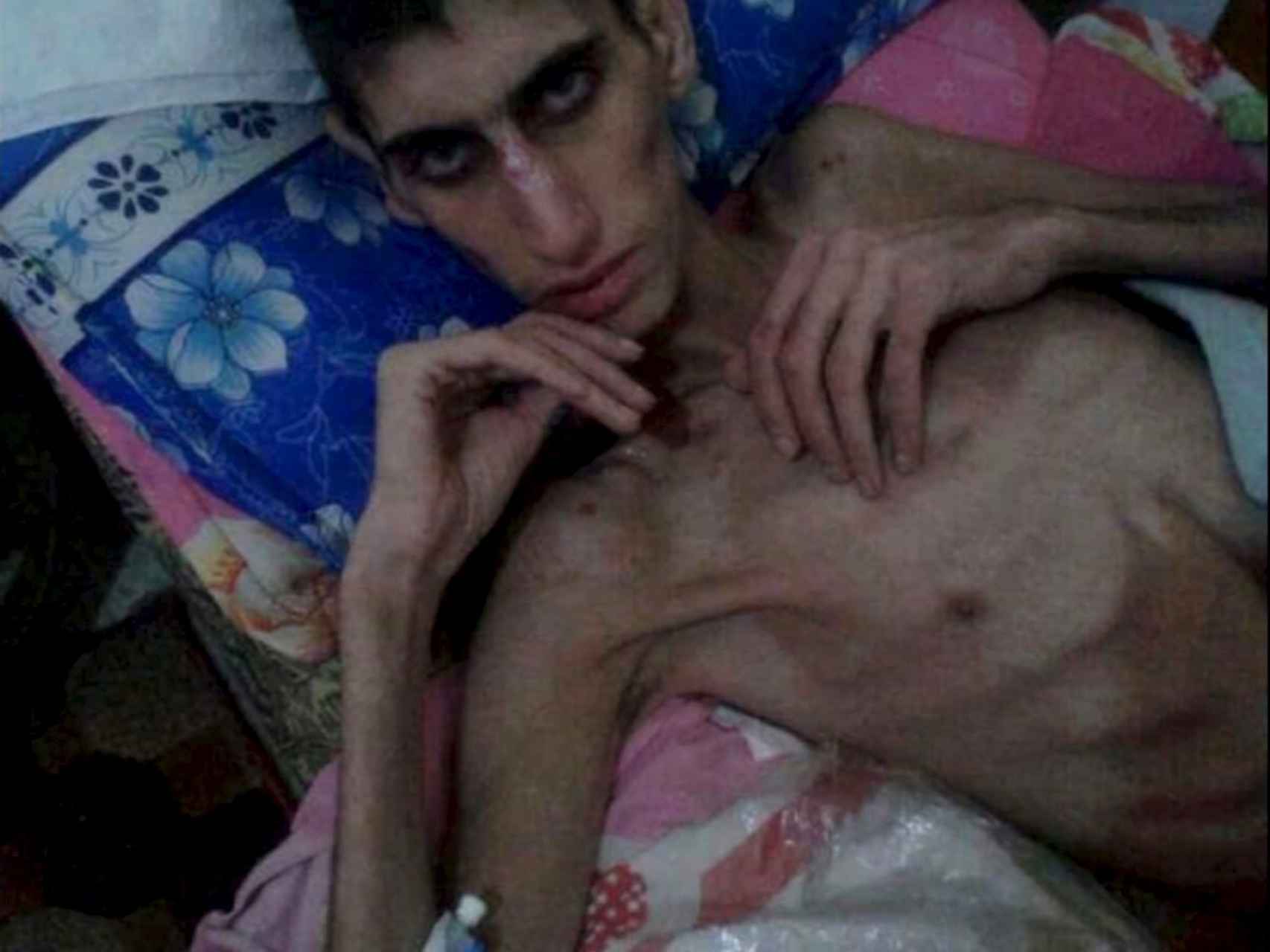 Un hombre demacrado supuestamente en Madaya en una foto sin datar.