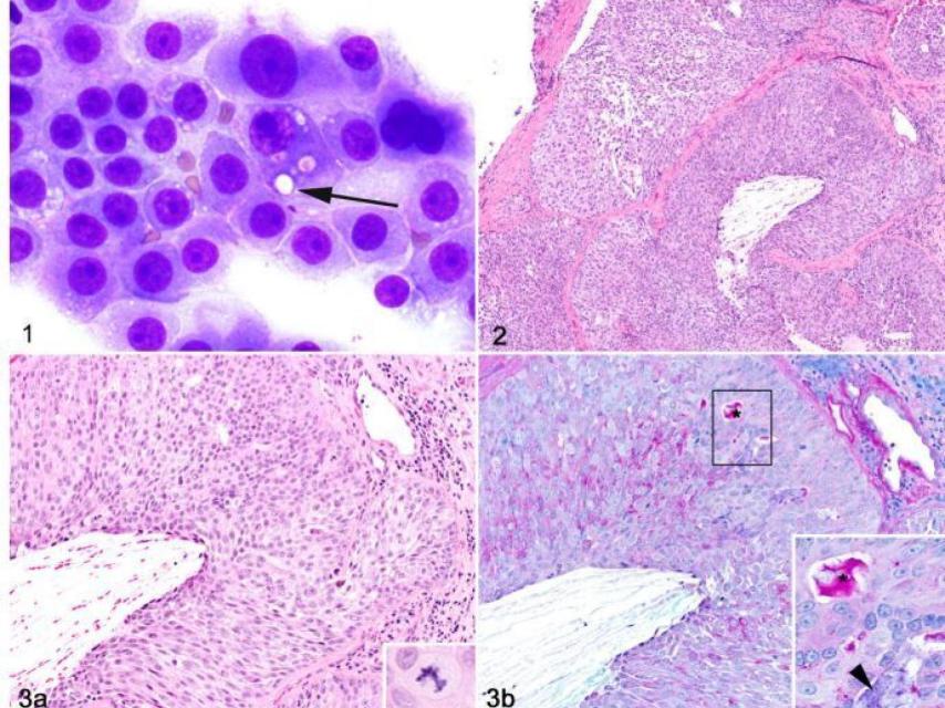 Adenocarcinoma detectado en el estudio.