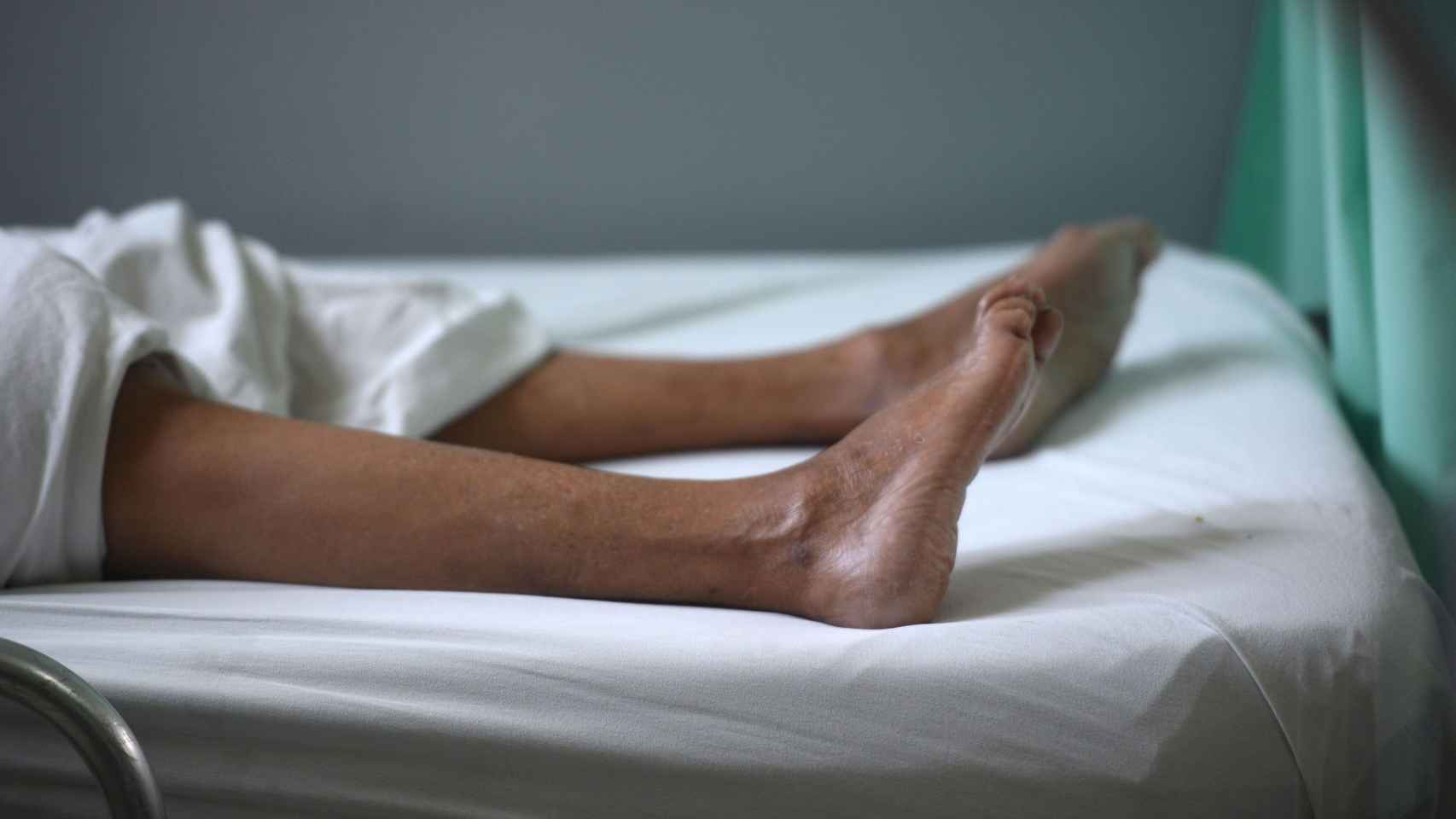 Las piernas de una paciente con Guillain-Barre.