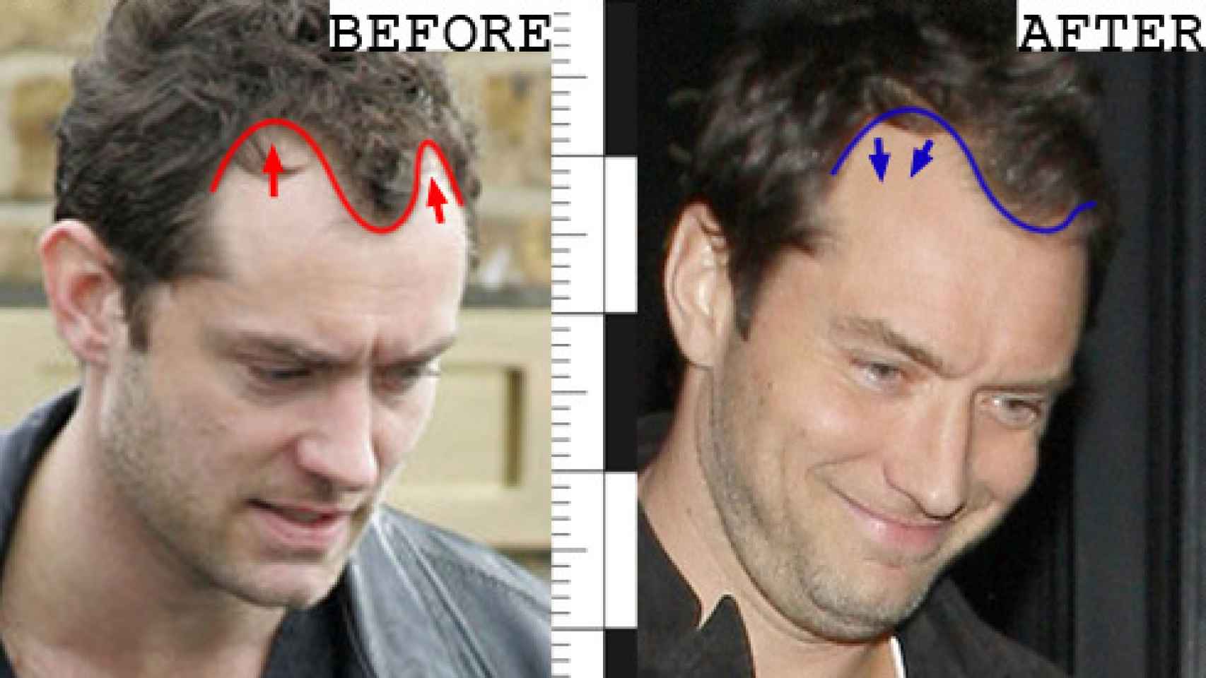 Jude Law antes y después del trasplante