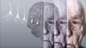 alzheimer