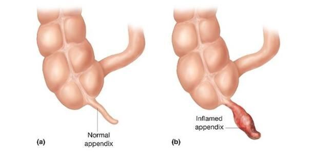 Comparacion-entre-un-apendice-normal-y-uno-inflamado