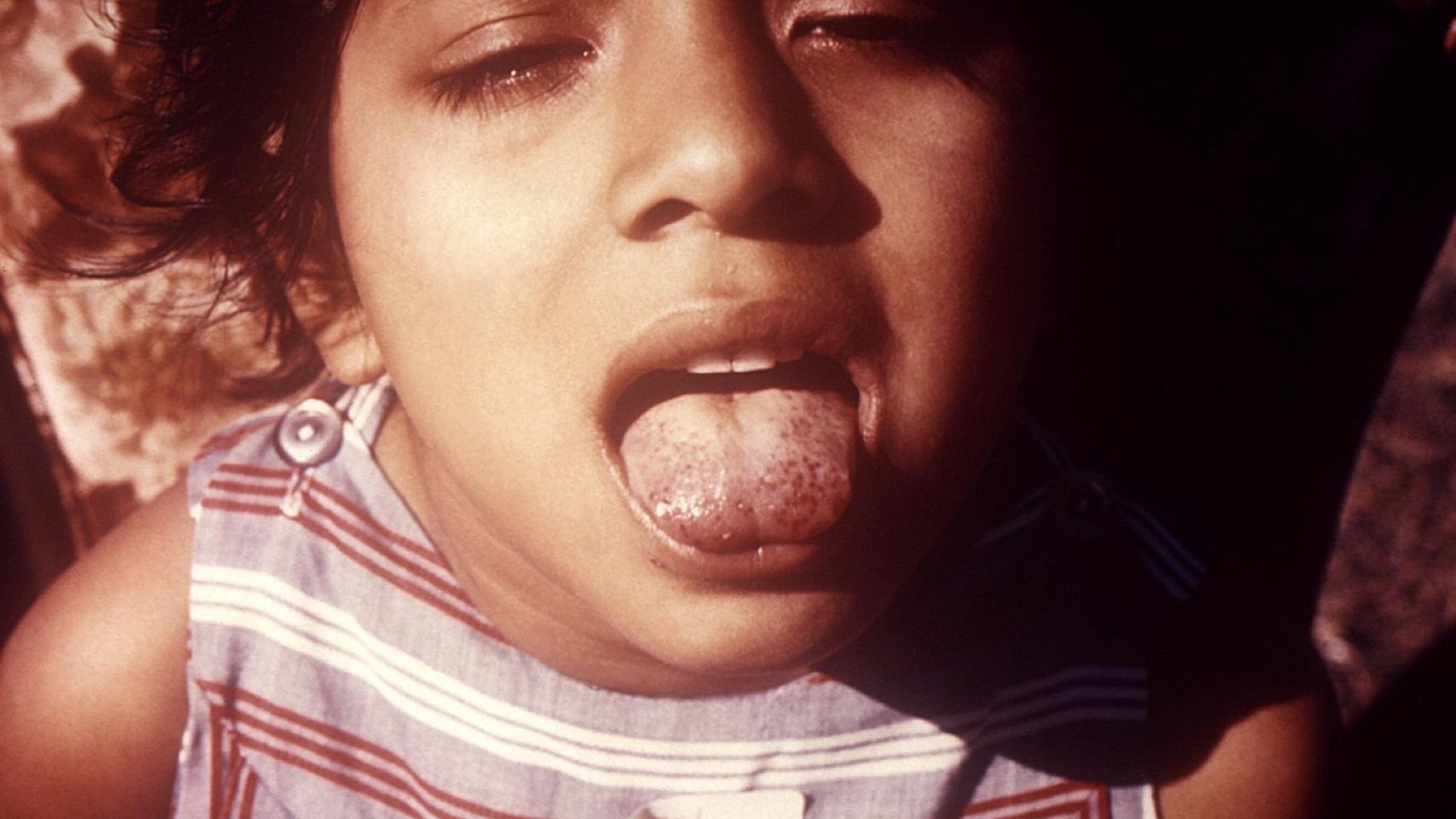 Una niña con marcas de escorbuto en la lengua.