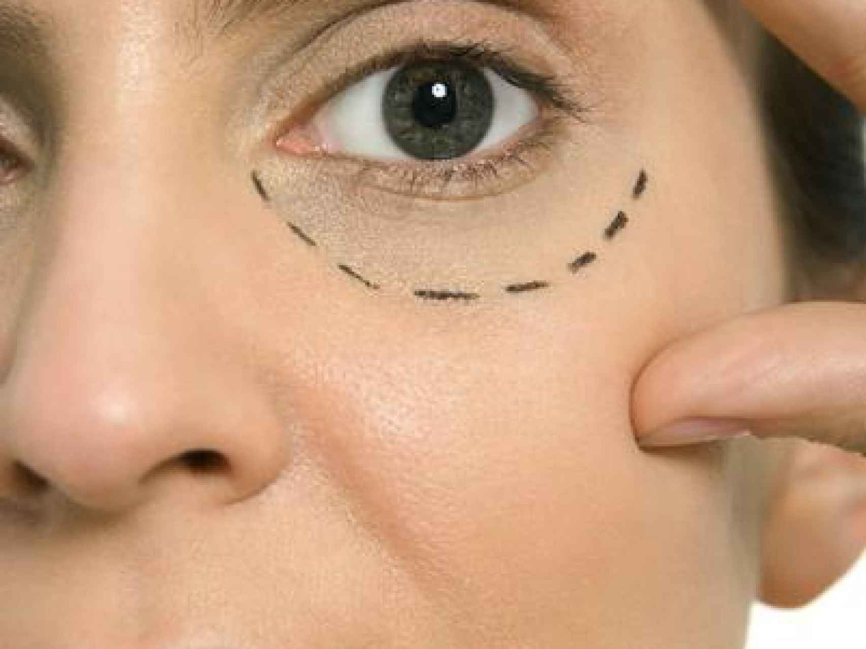 Preparación del ojo para una cirugía estética