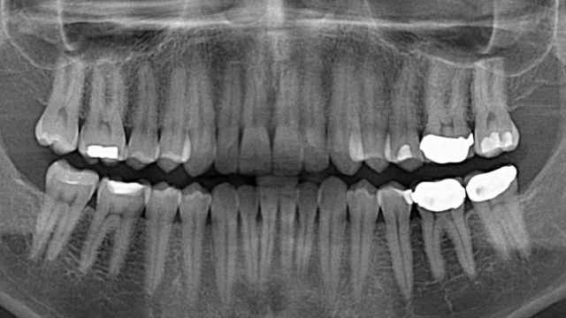 dientes-endodoncias