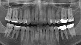 dientes-endodoncias