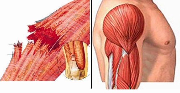 rabdomiolisis