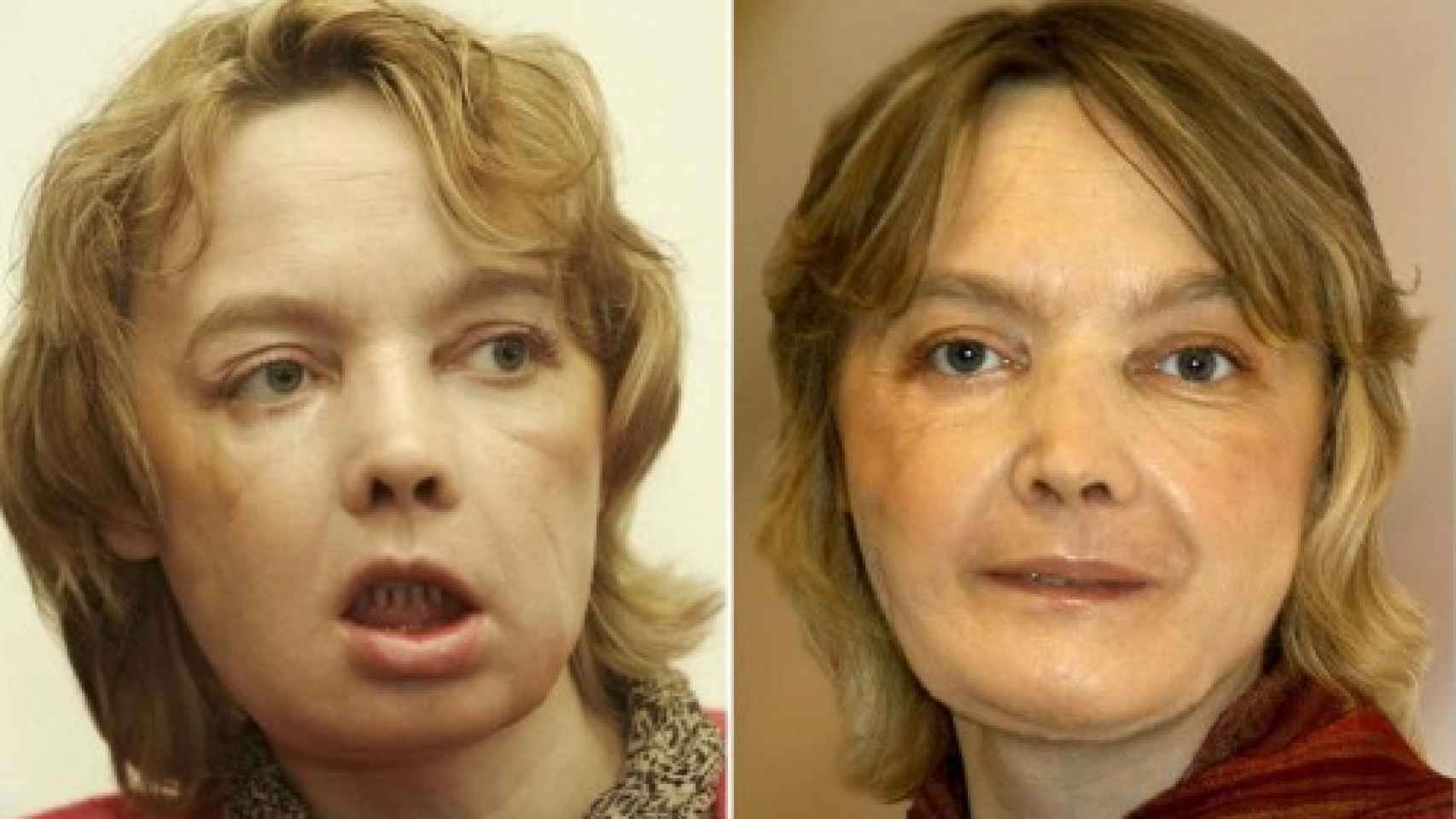Isabelle Dinoire, la primera mujer en recibir un trasplante de cara.