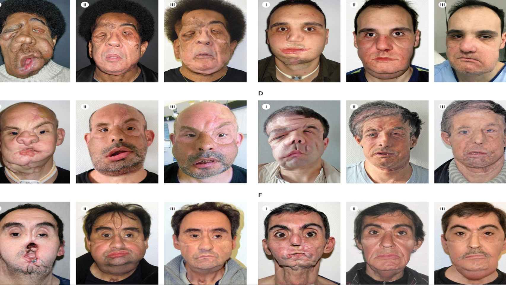 Algunos ejemplos de trasplantes de cara