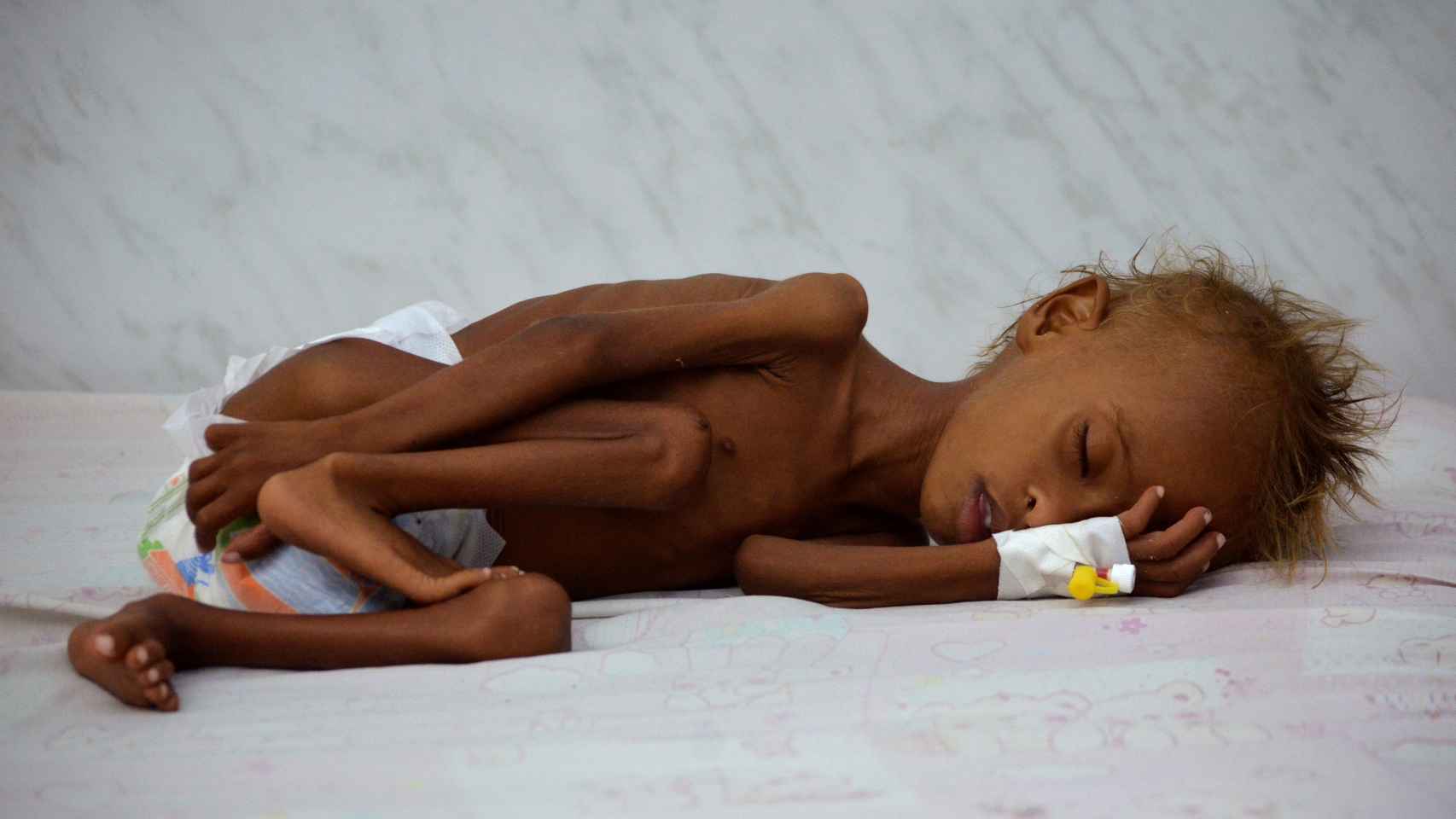 Salem Abdullah Musabih, de seis años, acostado en el hospital de Hodeida con una malnutrición severa.