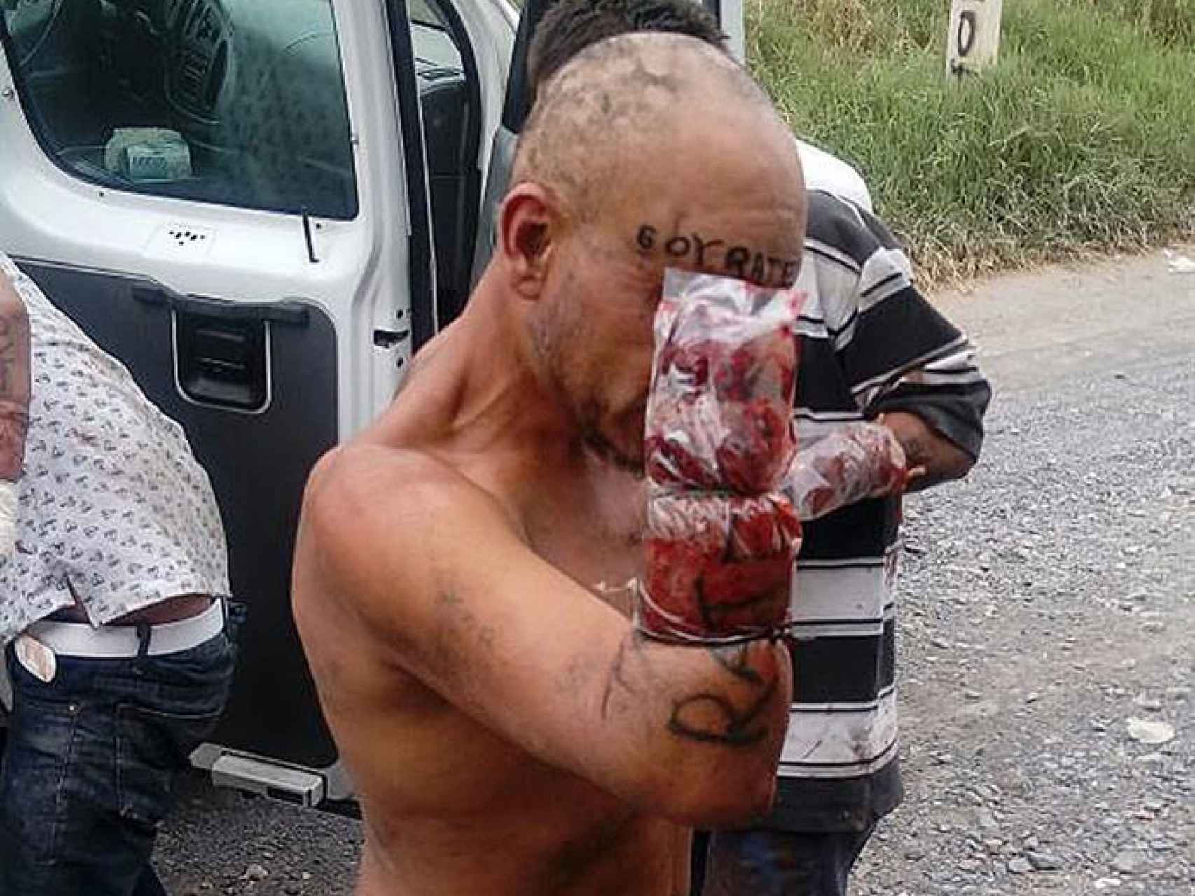 Una víctima muestra su amputación tras la agresión en Jalisco, México.