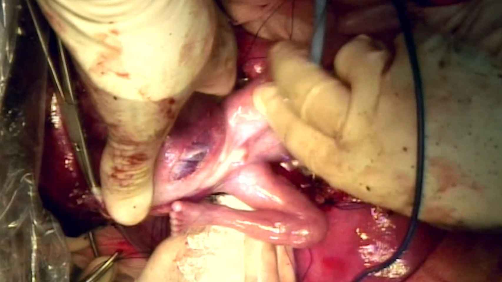 Imagen de la operación, que se grabó en video.