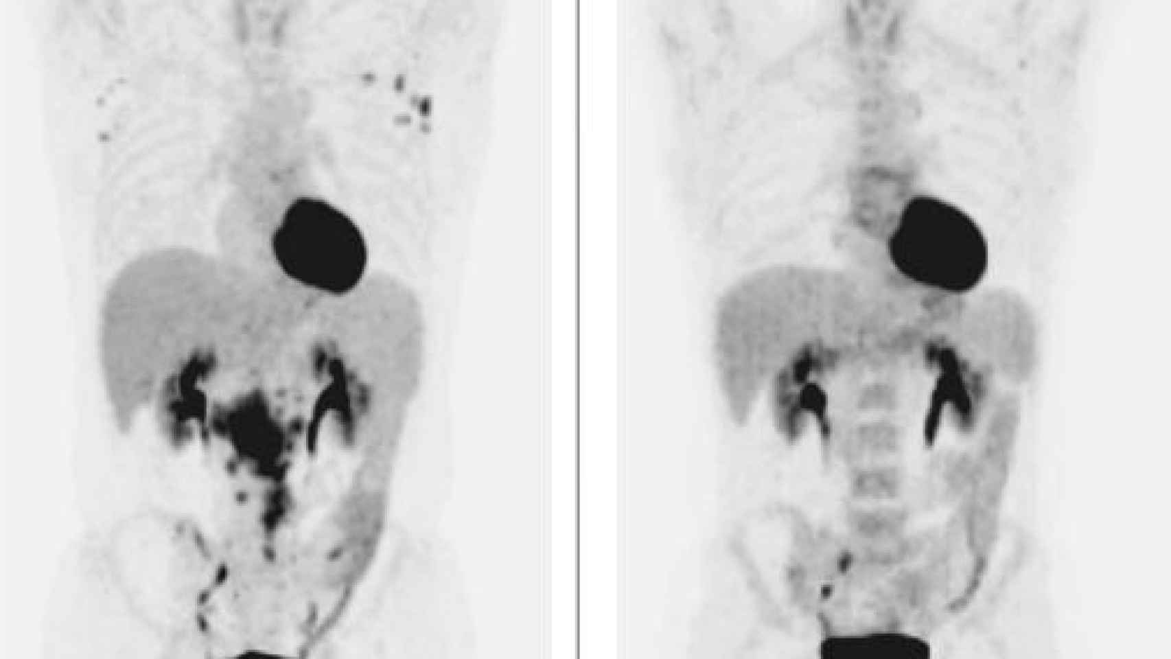 El tumor, antes y después del tratamiento para la hepatitis C.