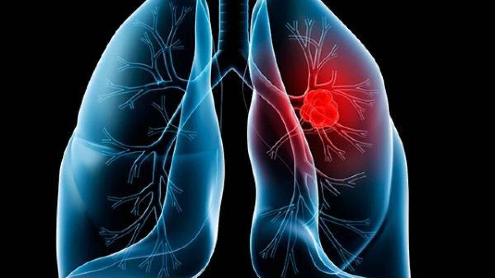 cancer_de_pulmon
