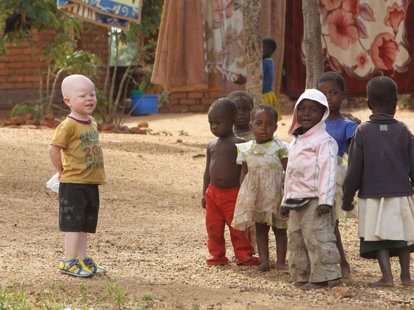 Un niño albino en África.