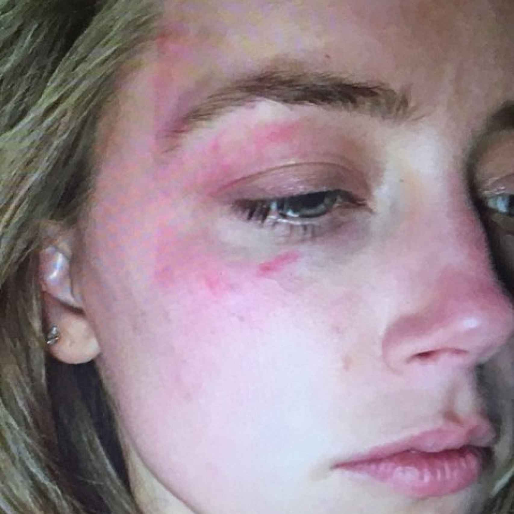 La fotografía con las lesiones que mostró Amber para probar la violencia doméstica que sufría.