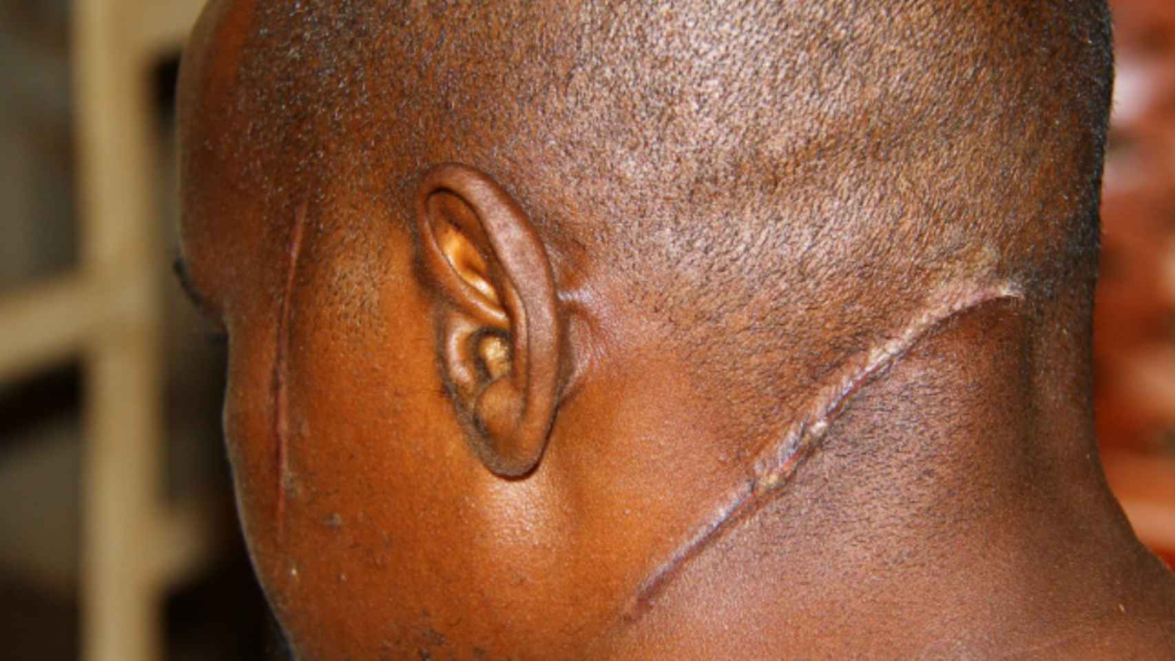 Musulmán de la localidad de Boda herido a machetazos por milicias cristianas.