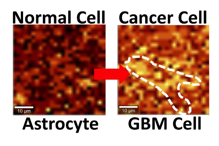 celula-cancerosa