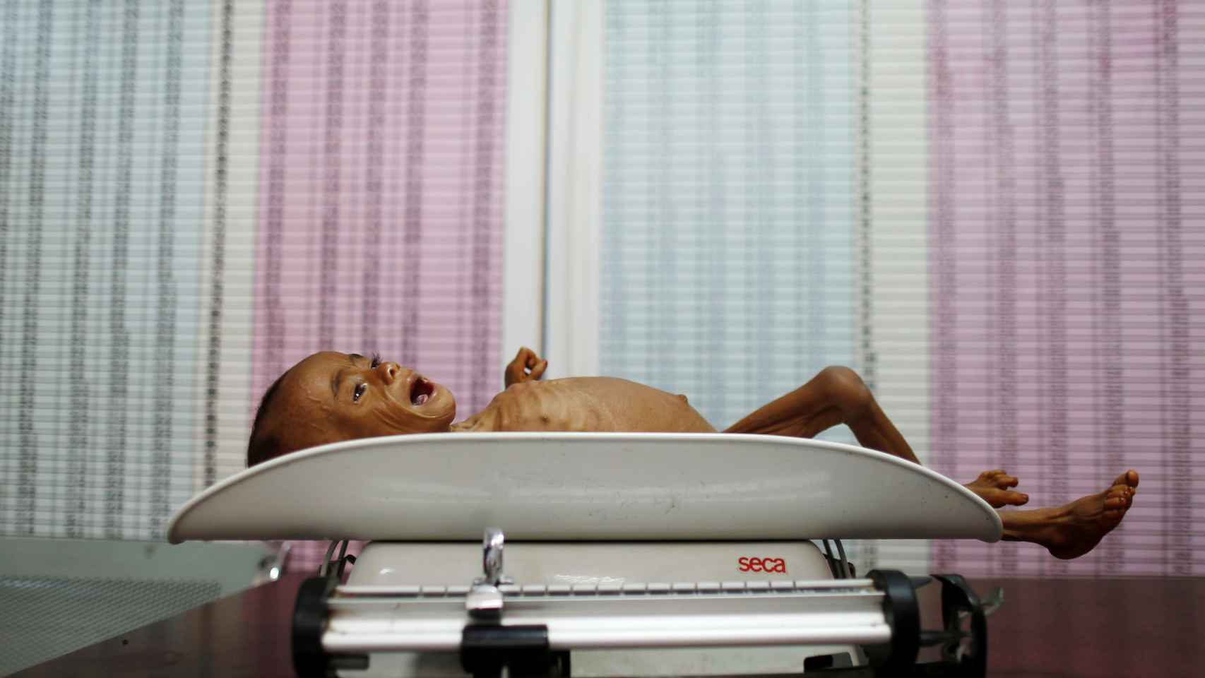 Un niño malnutrido es pesado en una báscula para bebés en Yemen.