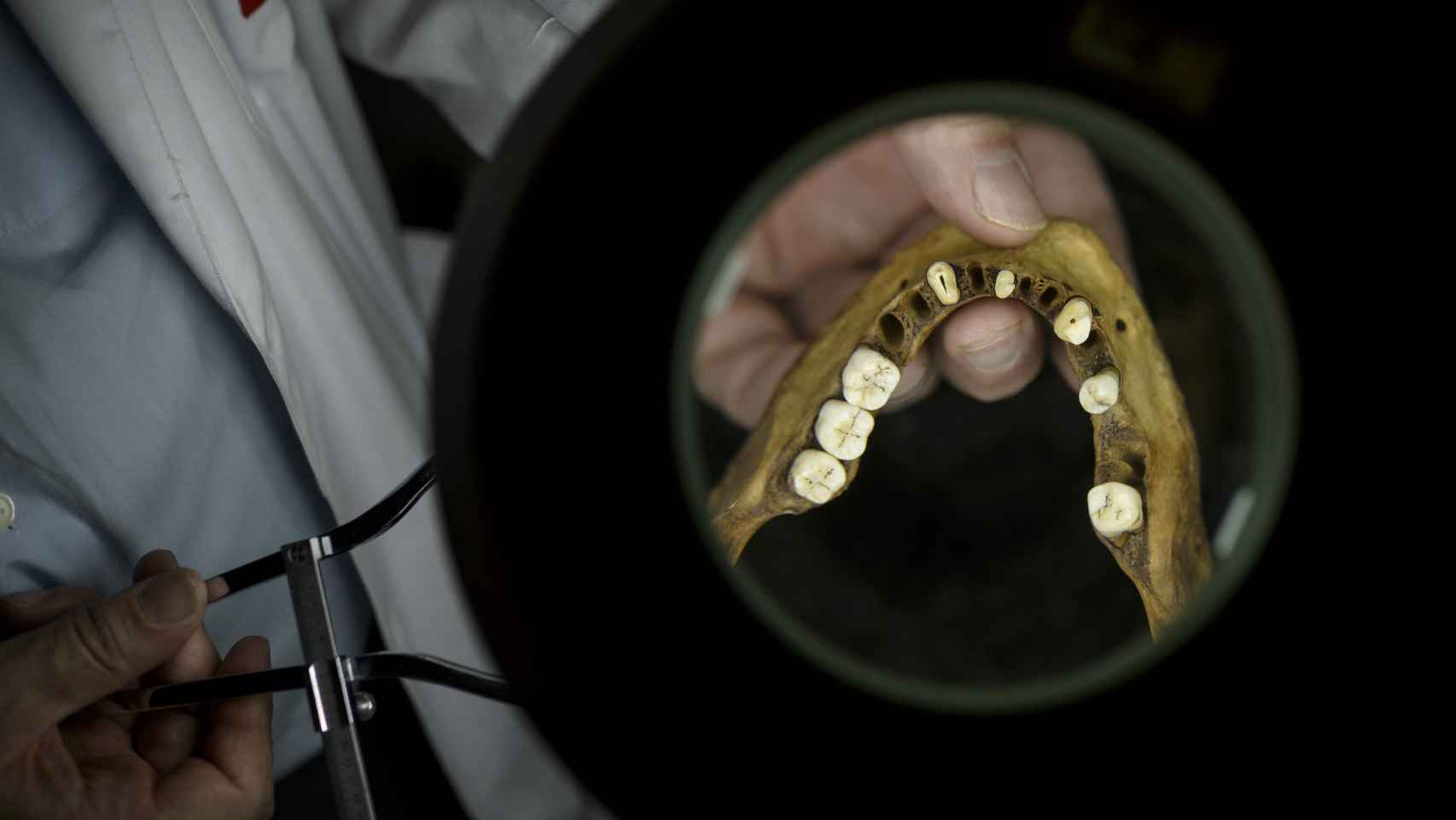 La dentadura también aporta detalles relevantes, como ortodoncias con materiales específicas de una zona determinada, que ayudan a identificar la identidad.