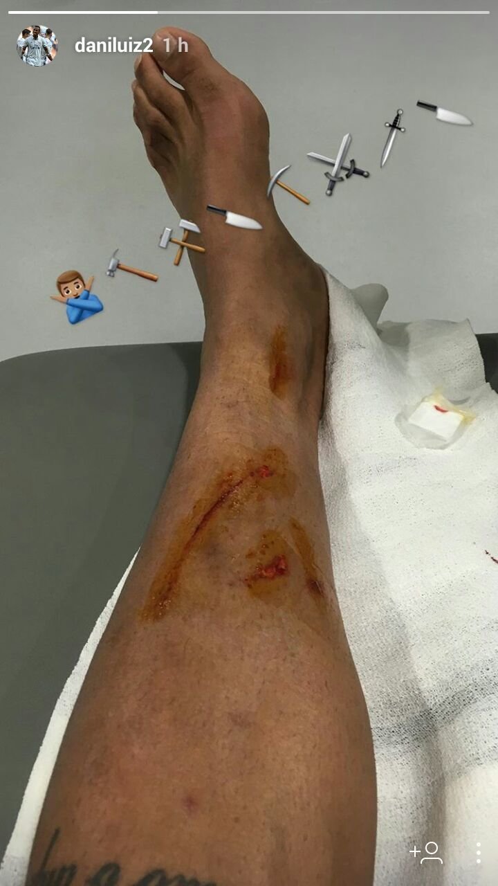 Dolorosa imagen: Danilo muestra cómo quedó su pierna