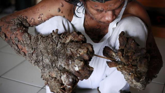 Un hombre árbol de Indonesia