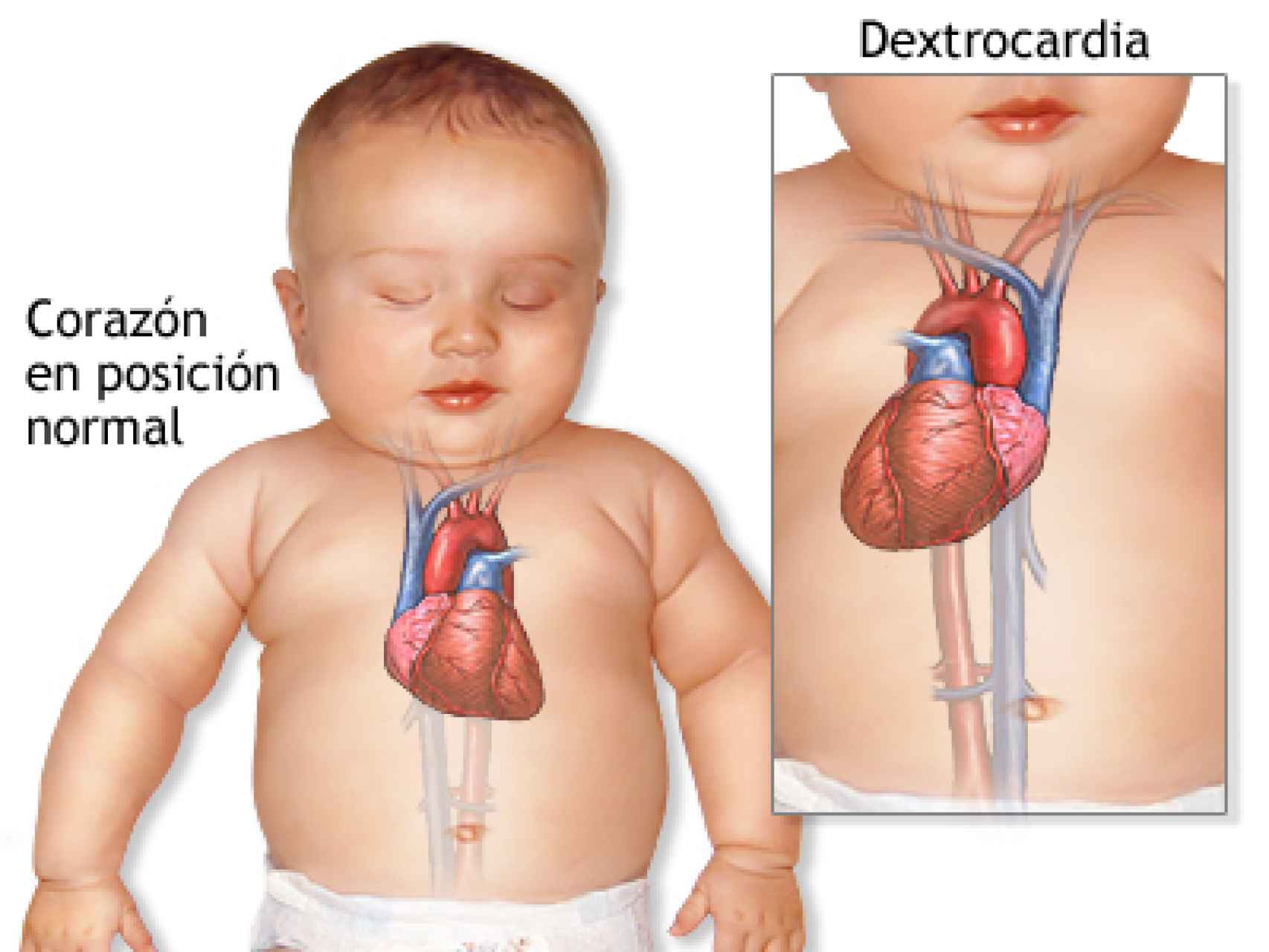 Explicación visual de la dextrocardia.