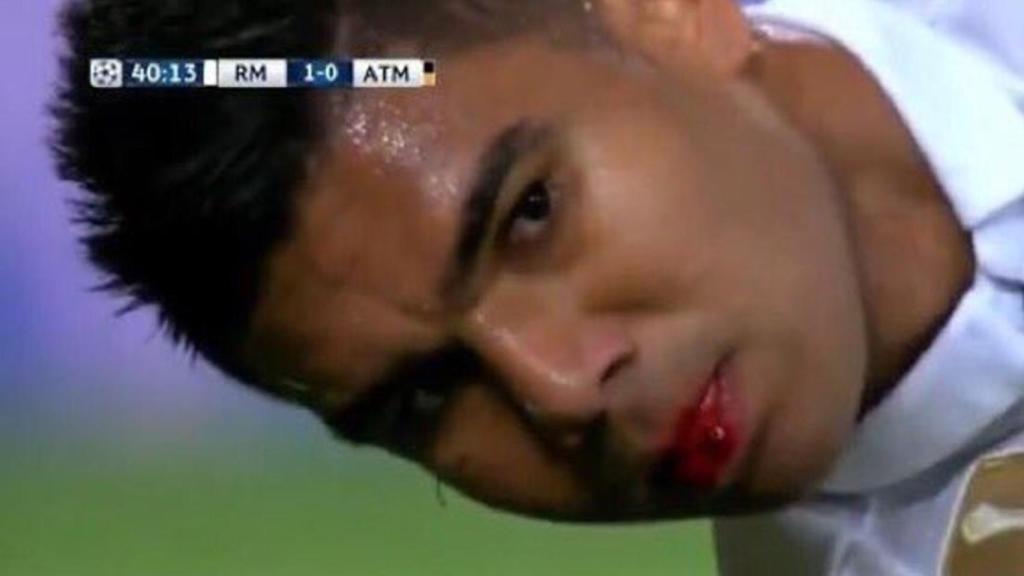 Así sangró Casemiro tras el codazo de Godín.