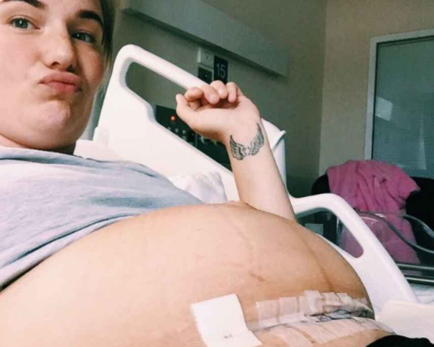 Olivia White muestra la herida en su barrida tras una cesárea