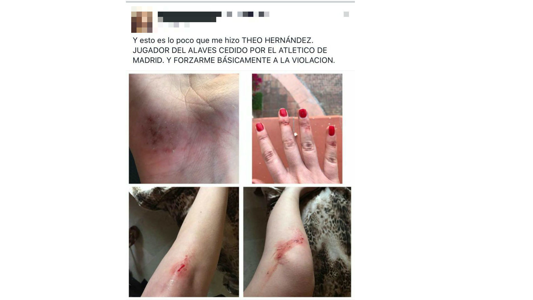 La presunta víctima de Theo Hernández difunde en la red imágenes de sus lesiones y luego las retira