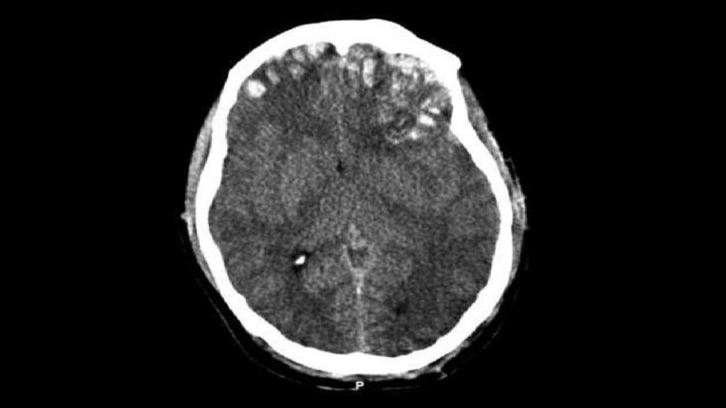 Un tac muestra la fractura craneal con hundimiento de un sujeto.