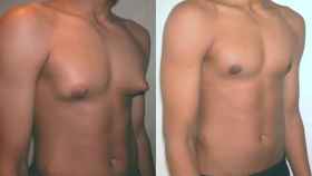 El antes y después de un hombre tras la operación de reducción de pecho.