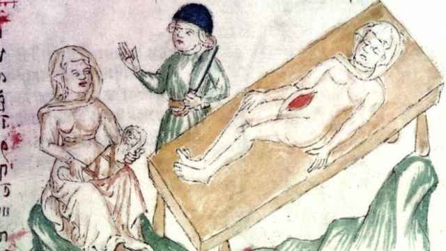 Iluistración de un parto con cesárea durante la Edad Media.
