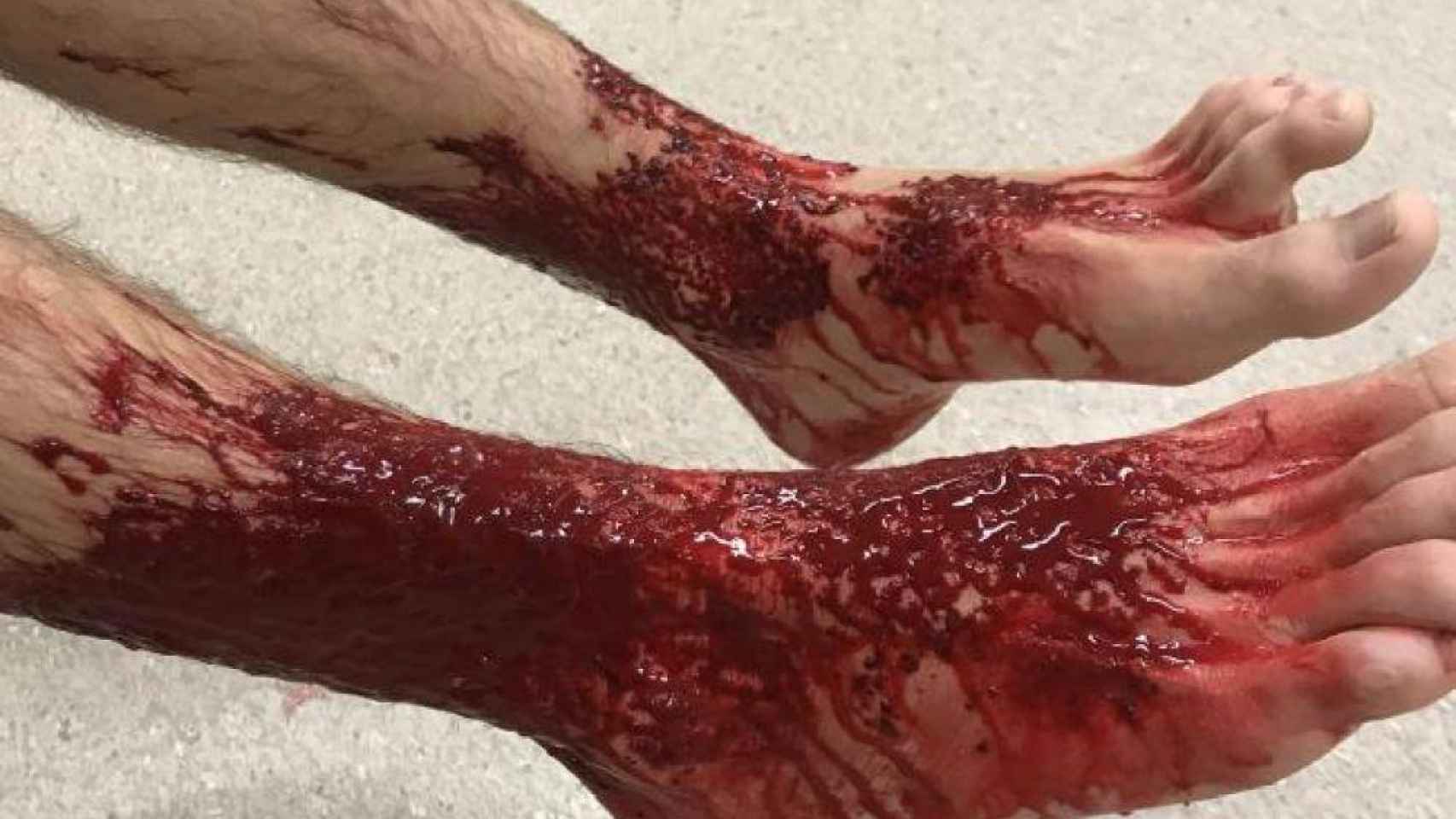 Heridas producidas por los piojos de mar