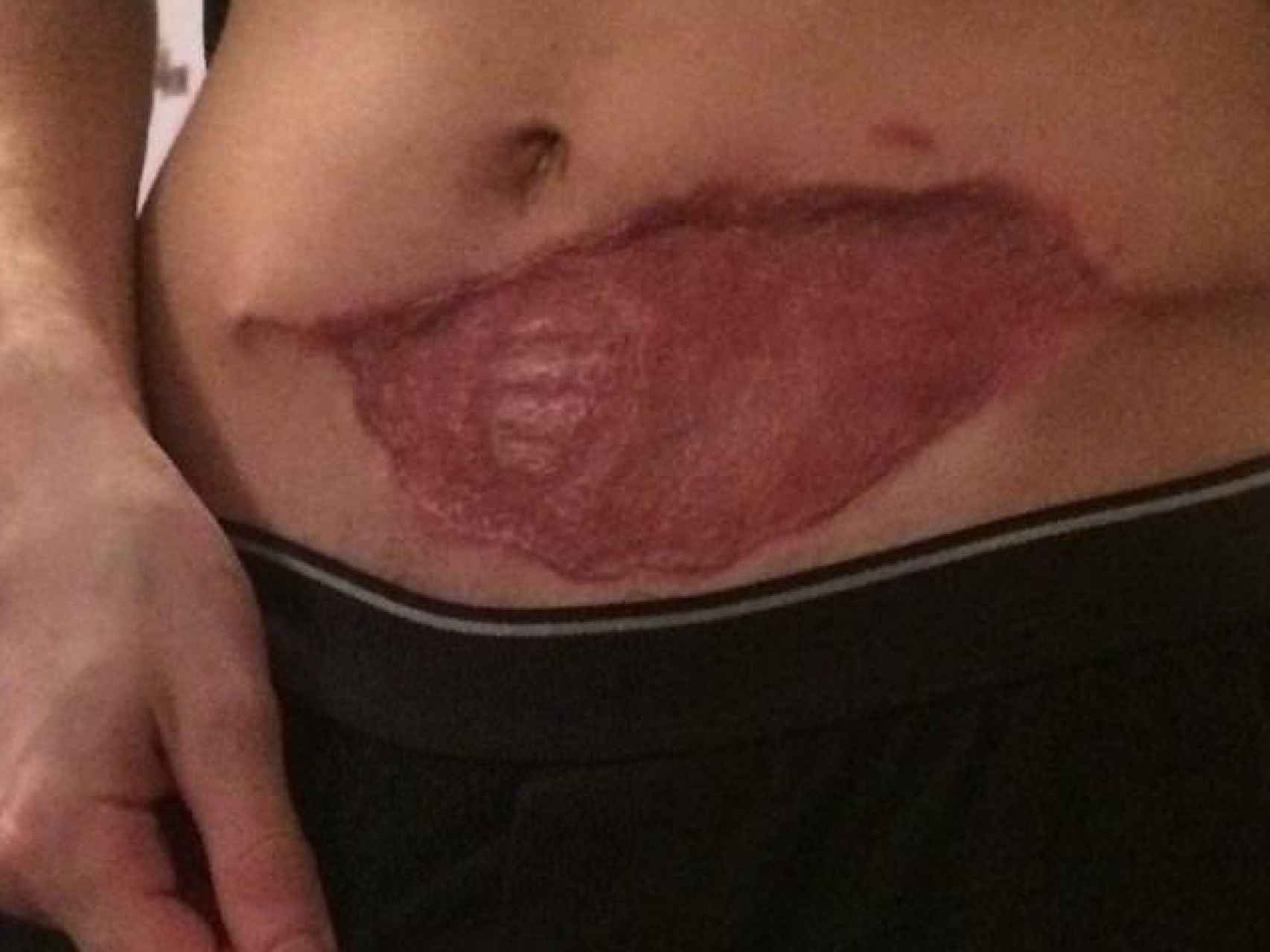 Cicatriz en el abdomen de Anthony Seward.