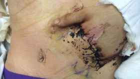 Imagen del abdomen de Anthony Seward con su mano cosida.