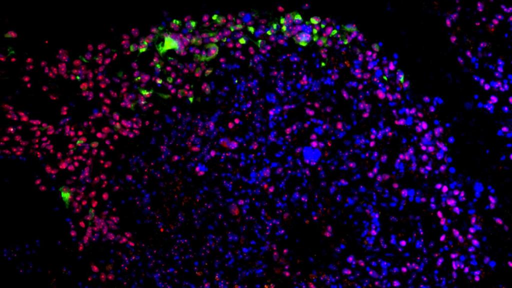 El virus del Zika (en verde) se adhiere a las células madre de un glioblastoma