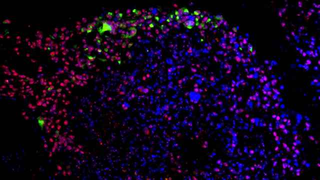 El virus del Zika (en verde) se adhiere a las células madre de un glioblastoma