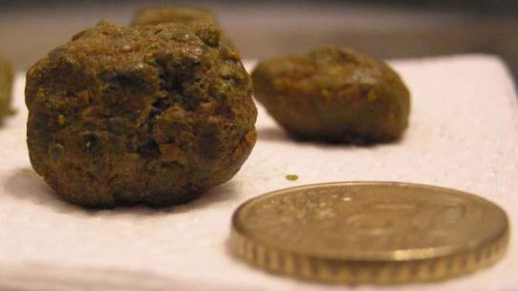 Dos piedras extraídas del riñón de otro paciente.