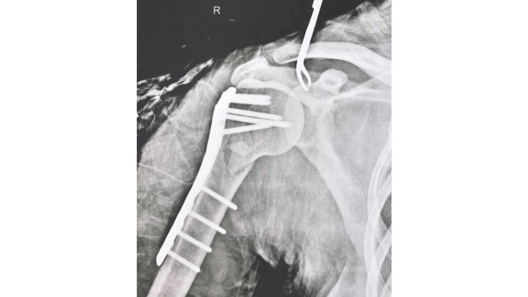 Radiografía del hombro de Amarna Miller tras la operación.