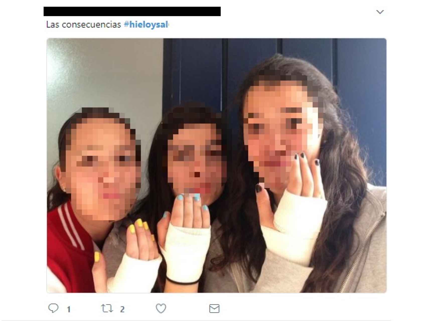 Tres jóvenes lucen en Twitter sus heridas por jugar al reto del hielo y la sal.