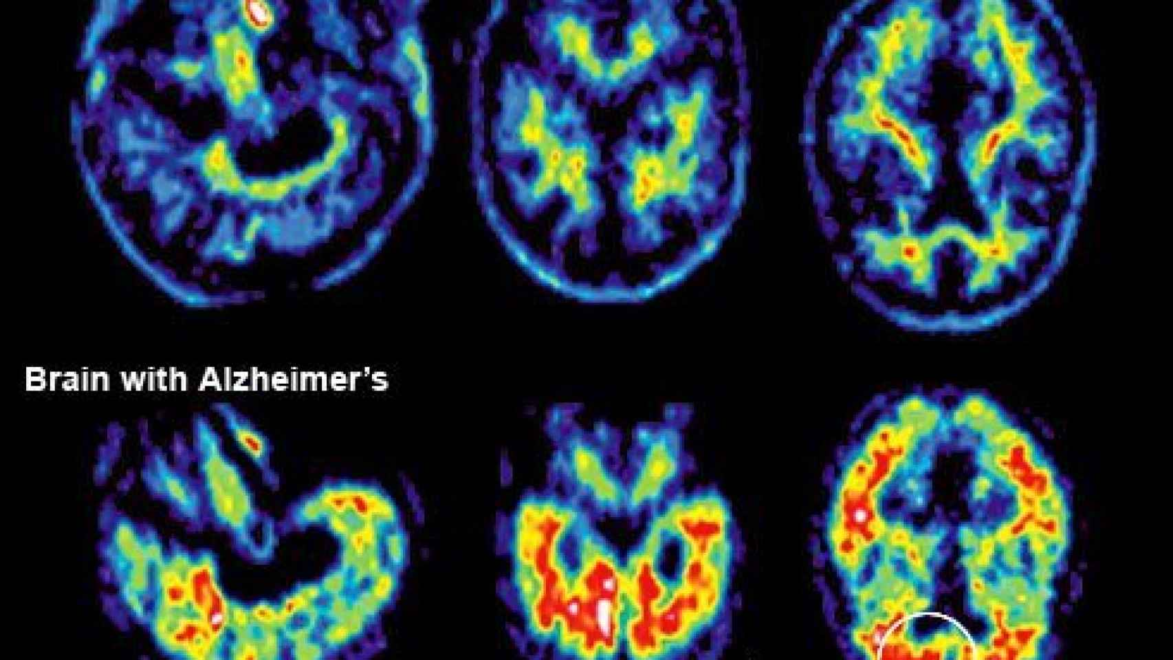 Una resonancia magnetica de un paciente con alzhéimer.