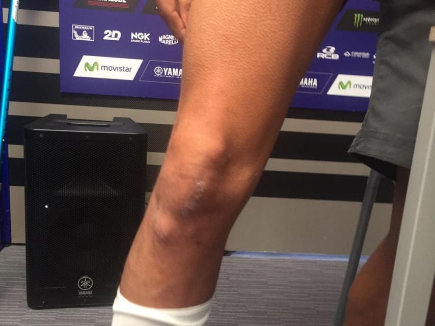 Las heridas de guerra de Valentino Rossi enseñadas por él mismo.