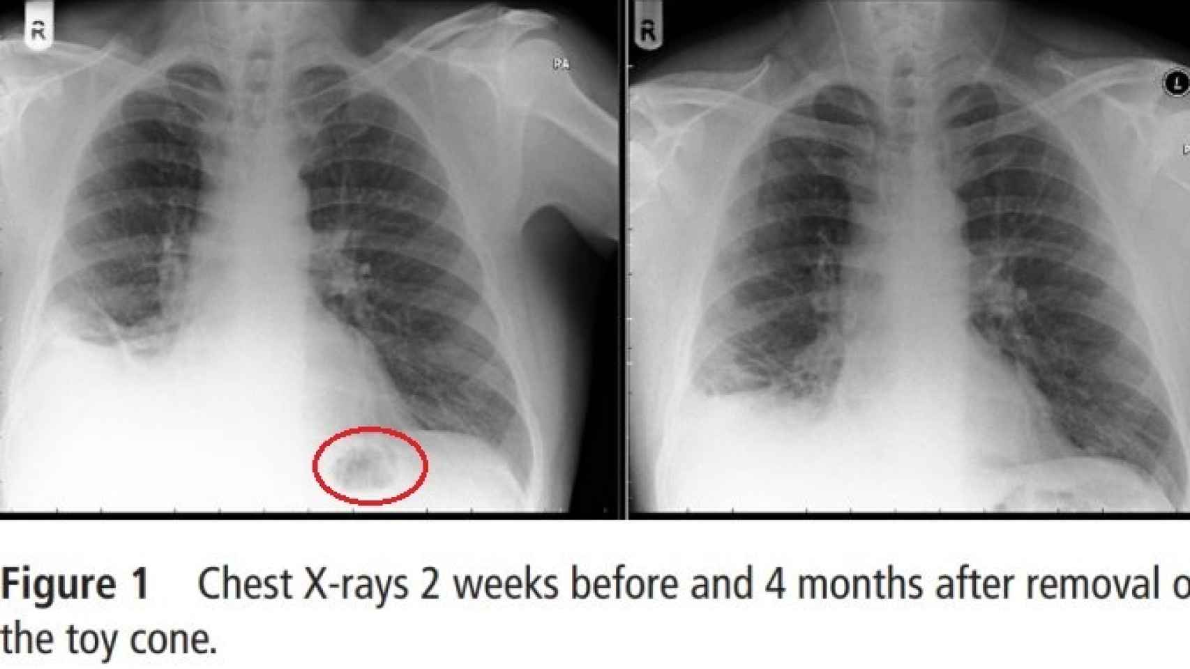 Los pulmones del paciente antes y después de que le fuese extraído el cono de plástico.