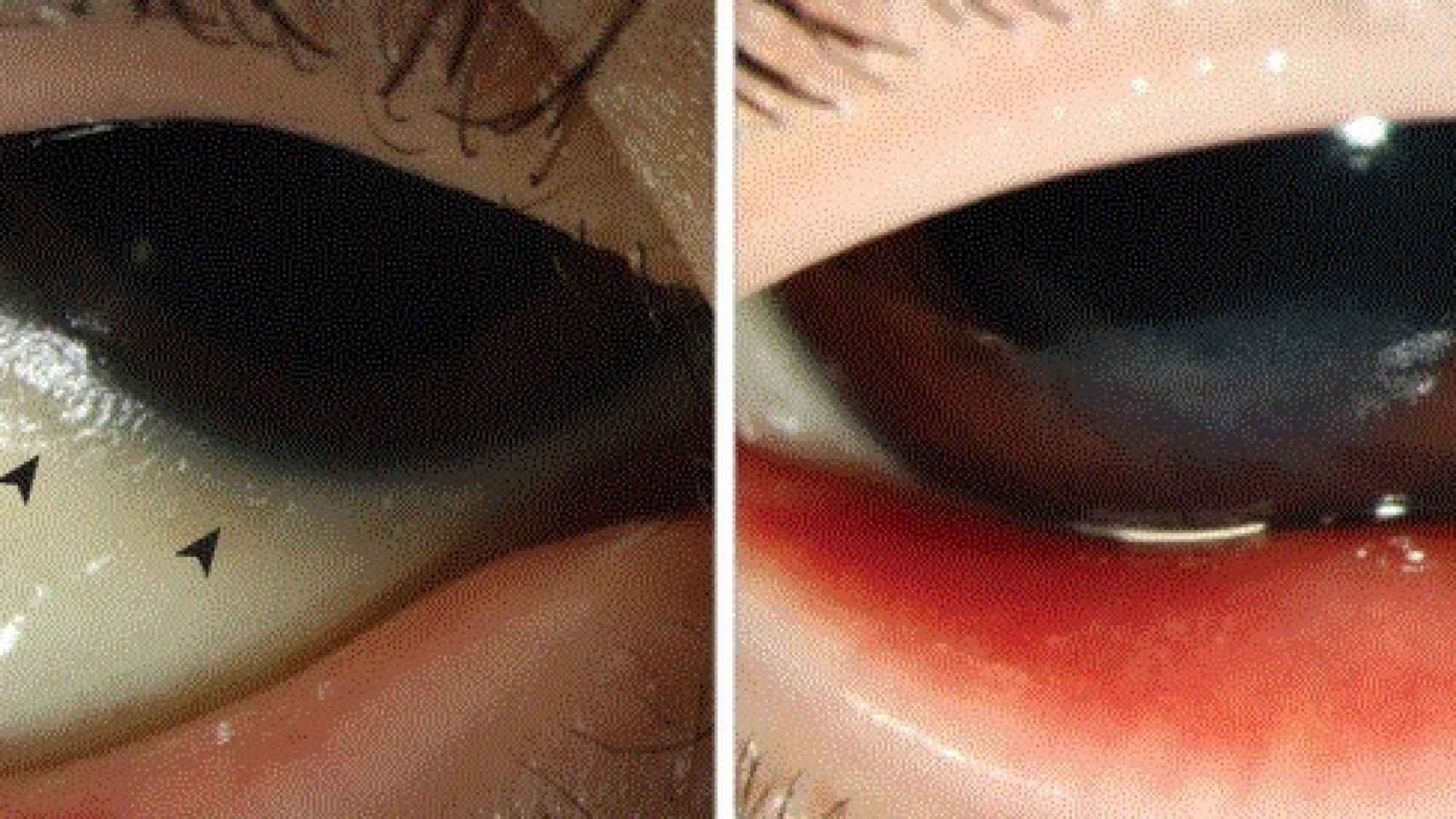 Los ojos del niño, antes y después del tratamiento.
