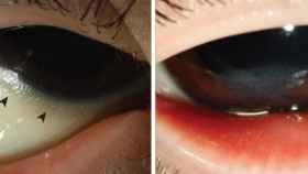 Los ojos del niño, antes y después del tratamiento.